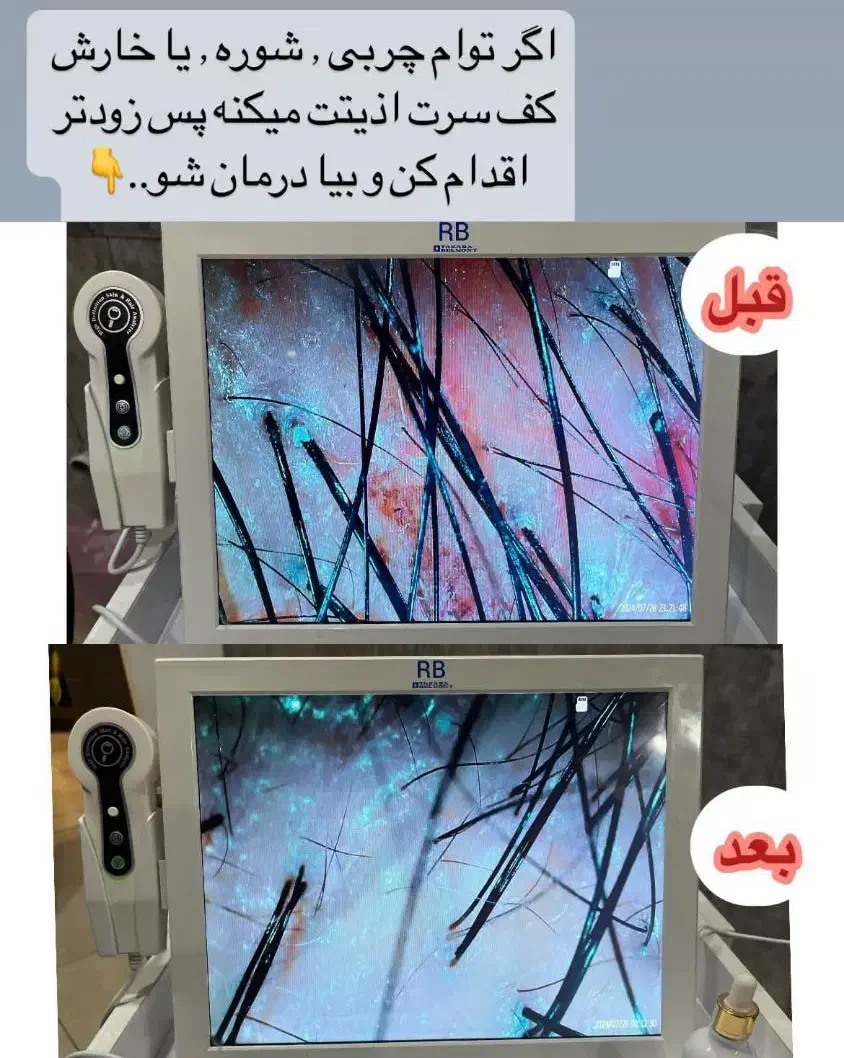 درمان ریزش مو،پوسته،شوره،خارش و بیماری های قارچی|خدمات آرایشگری و زیبایی|شیراز, شهرک امیر کبیر|دیوار