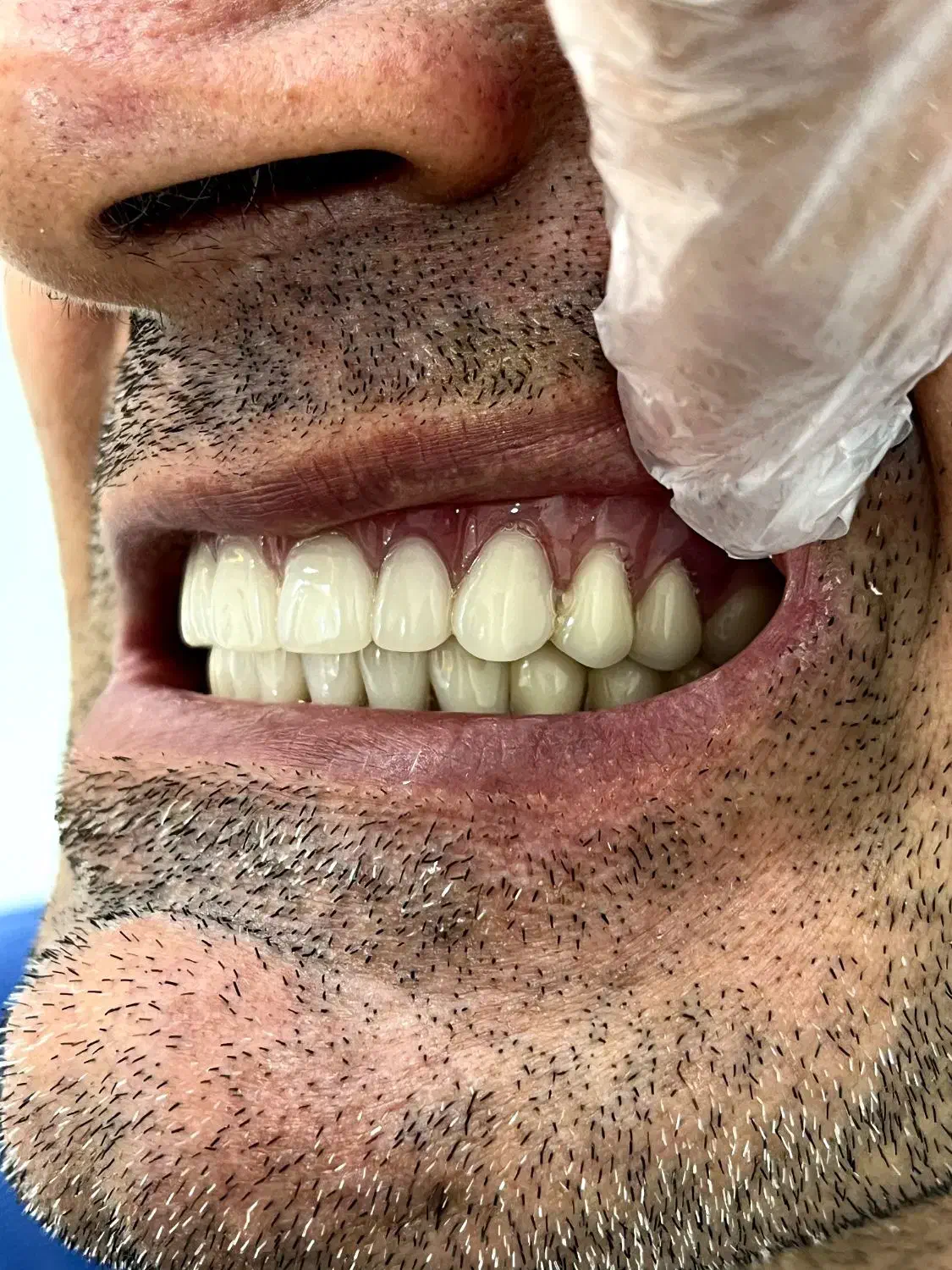 دندانسازی آوا قرارداد مستقیم کلیه بیمه ها|خدمات آرایشگری و زیبایی|خرم‌آباد, |دیوار