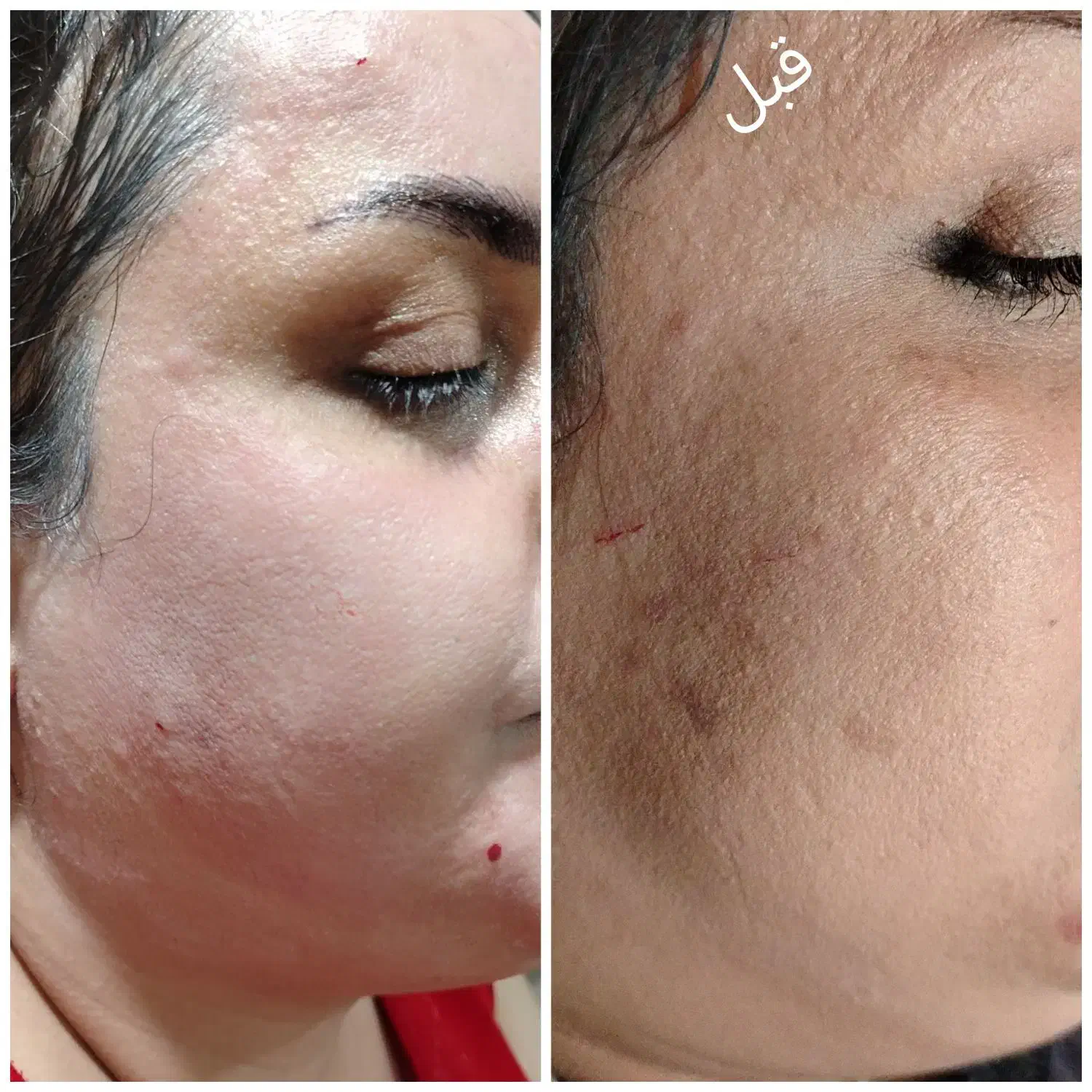 پاکسازی و جوانسازی پوست با آکوا فیشیال|خدمات آرایشگری و زیبایی|اردبیل, |دیوار