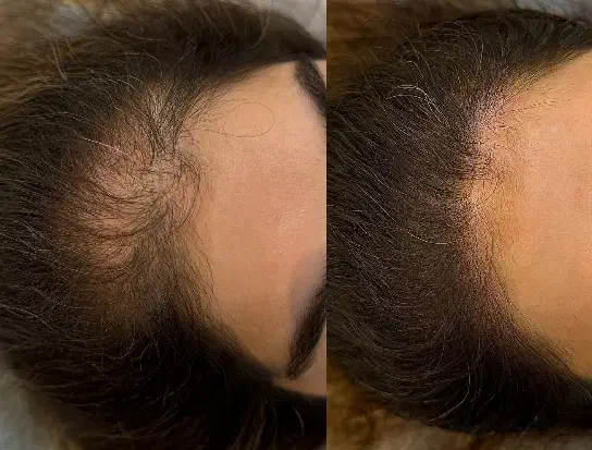 میکرواسکالپ تخصصی با جدیدترین متدvip|خدمات آرایشگری و زیبایی|مشهد, گوهرشاد|دیوار