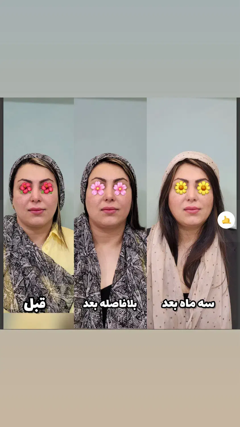 آغازجشنواره زیبایی پوست باهایفوتراپی وآراف فرکشنال|خدمات آرایشگری و زیبایی|قم, زینبیه|دیوار