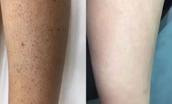 لیزر موهای زائد به صورت دائم با بهترین دستگاه لیزر|خدمات آرایشگری و زیبایی|کرمانشاه, |دیوار