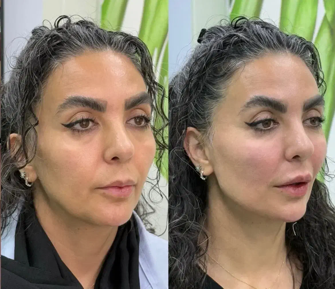 تزریق ژل و بوتاکس و مادلینگ عربی|خدمات آرایشگری و زیبایی|کرمانشاه, |دیوار