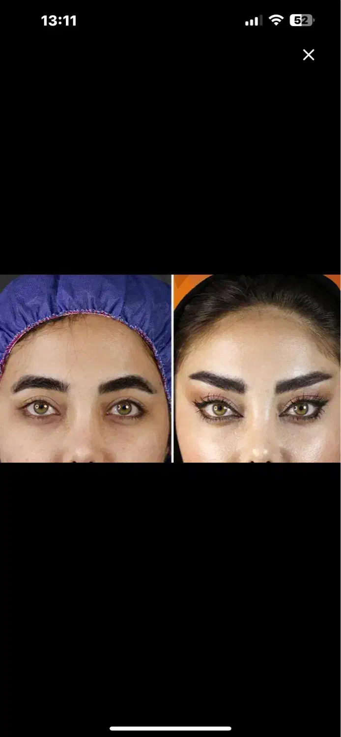 جشنواره تخفیف جراحی زیبایی شقیقه،بلفارو،دایرکت|خدمات آرایشگری و زیبایی|پرند, فاز ۲|دیوار