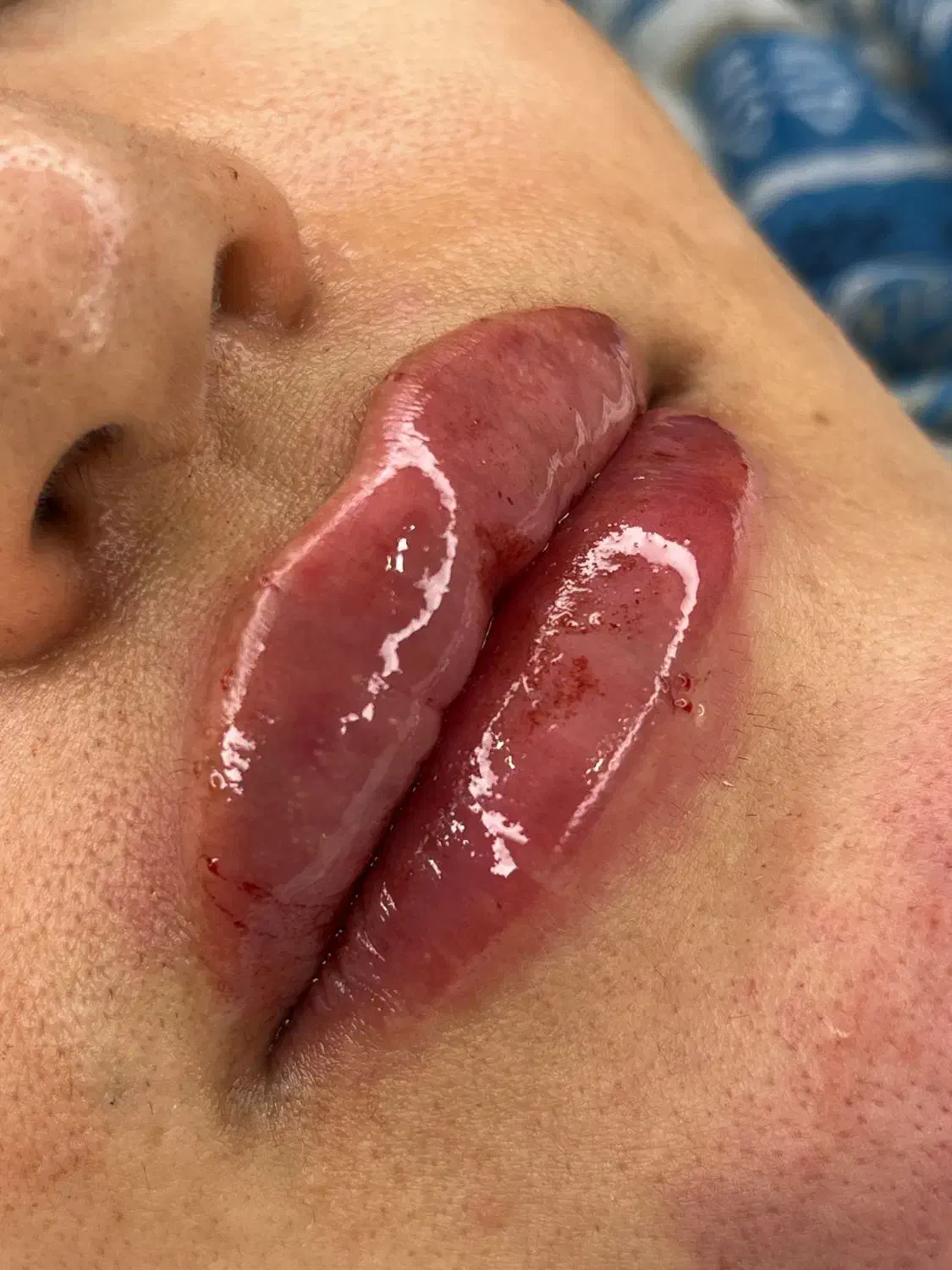 تزریق ژل لب روسی طبیعی توسط پزشک متخصص|خدمات آرایشگری و زیبایی|چهاردانگه (تهران), |دیوار