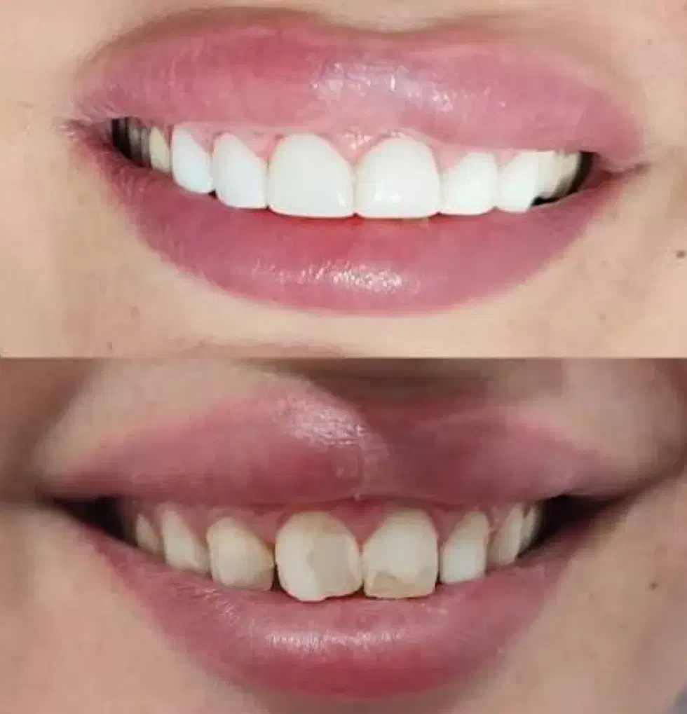 لمینت مترحک دندان اصل|آرایشی، بهداشتی، درمانی|ایلام, |دیوار