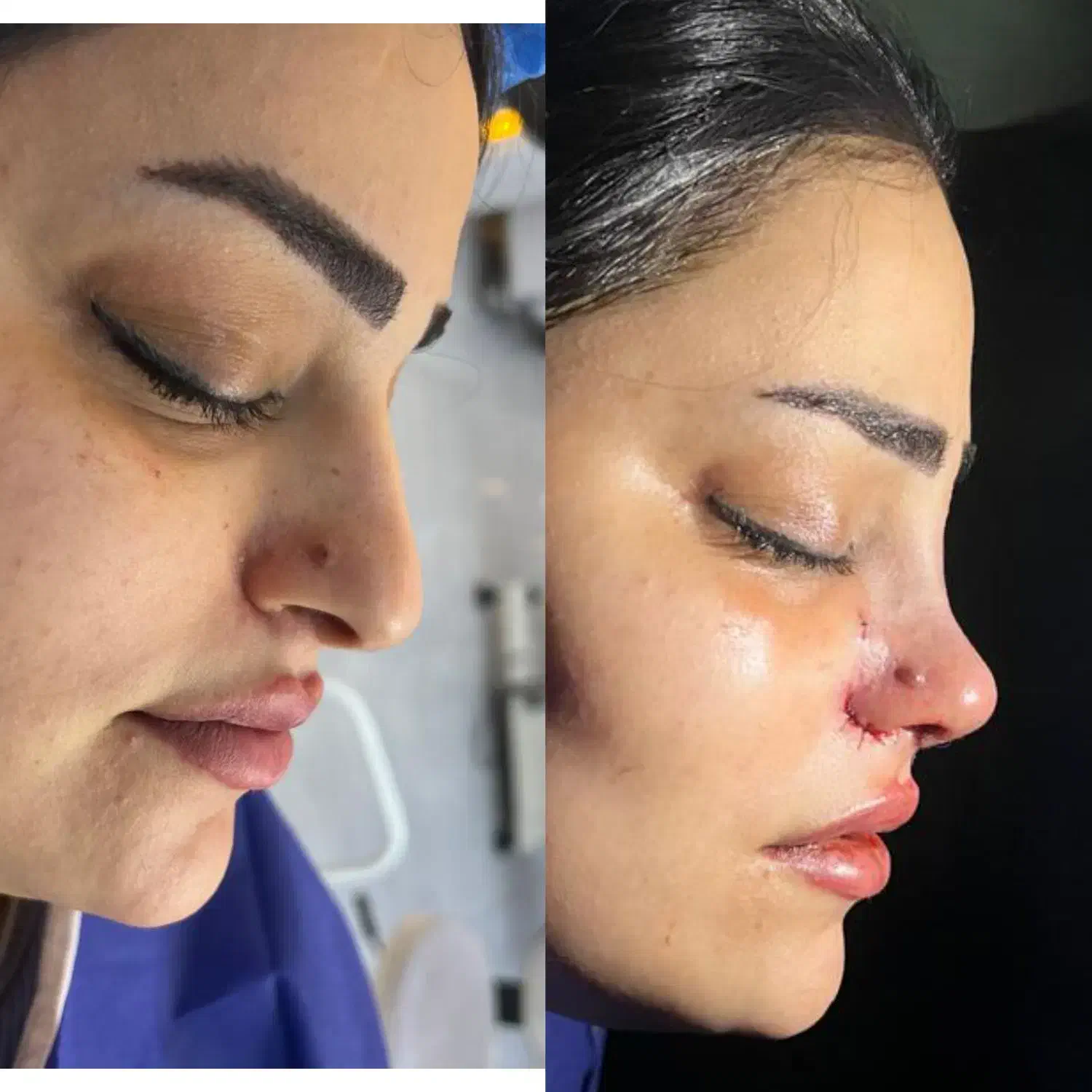 عمل زیبایی بینی با بهترین متد|خدمات آرایشگری و زیبایی|کرج, اتحاد|دیوار