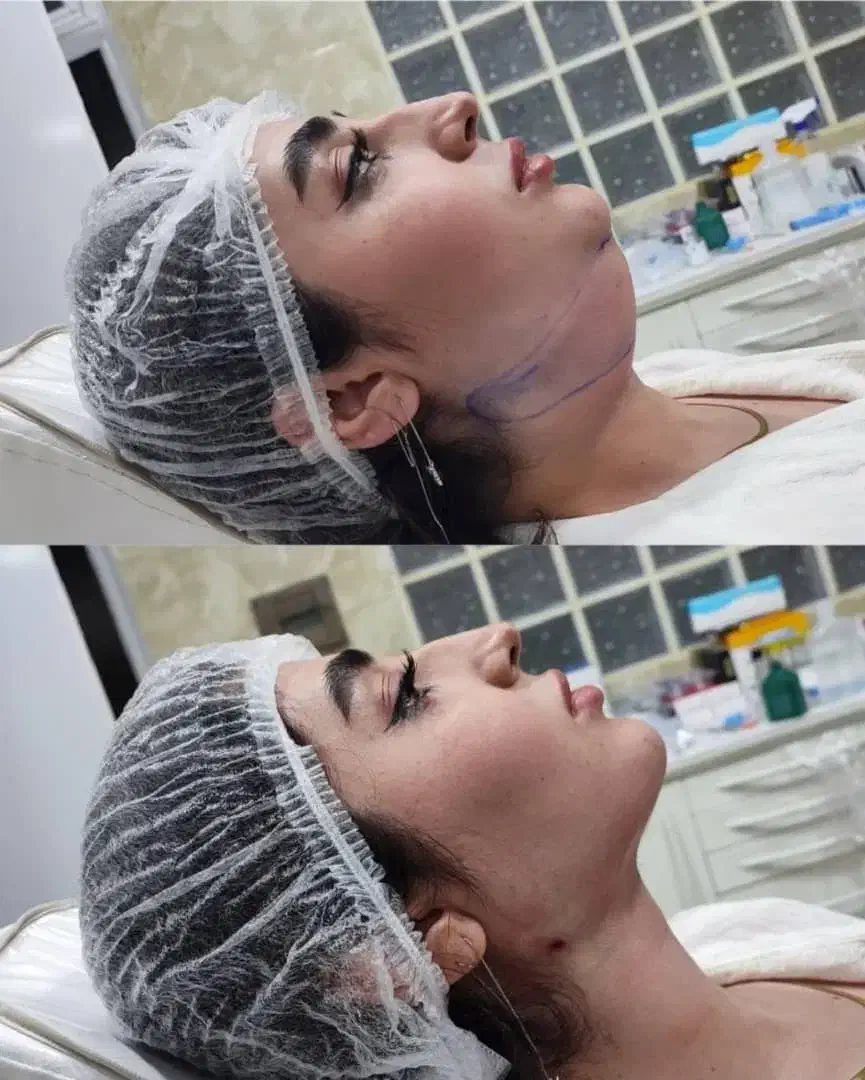 پزشک جراحی بلفا غبغب نخ لیفت کلاژن آنزیم ژل فیلر|خدمات آرایشگری و زیبایی|کرج, گوهردشت|دیوار