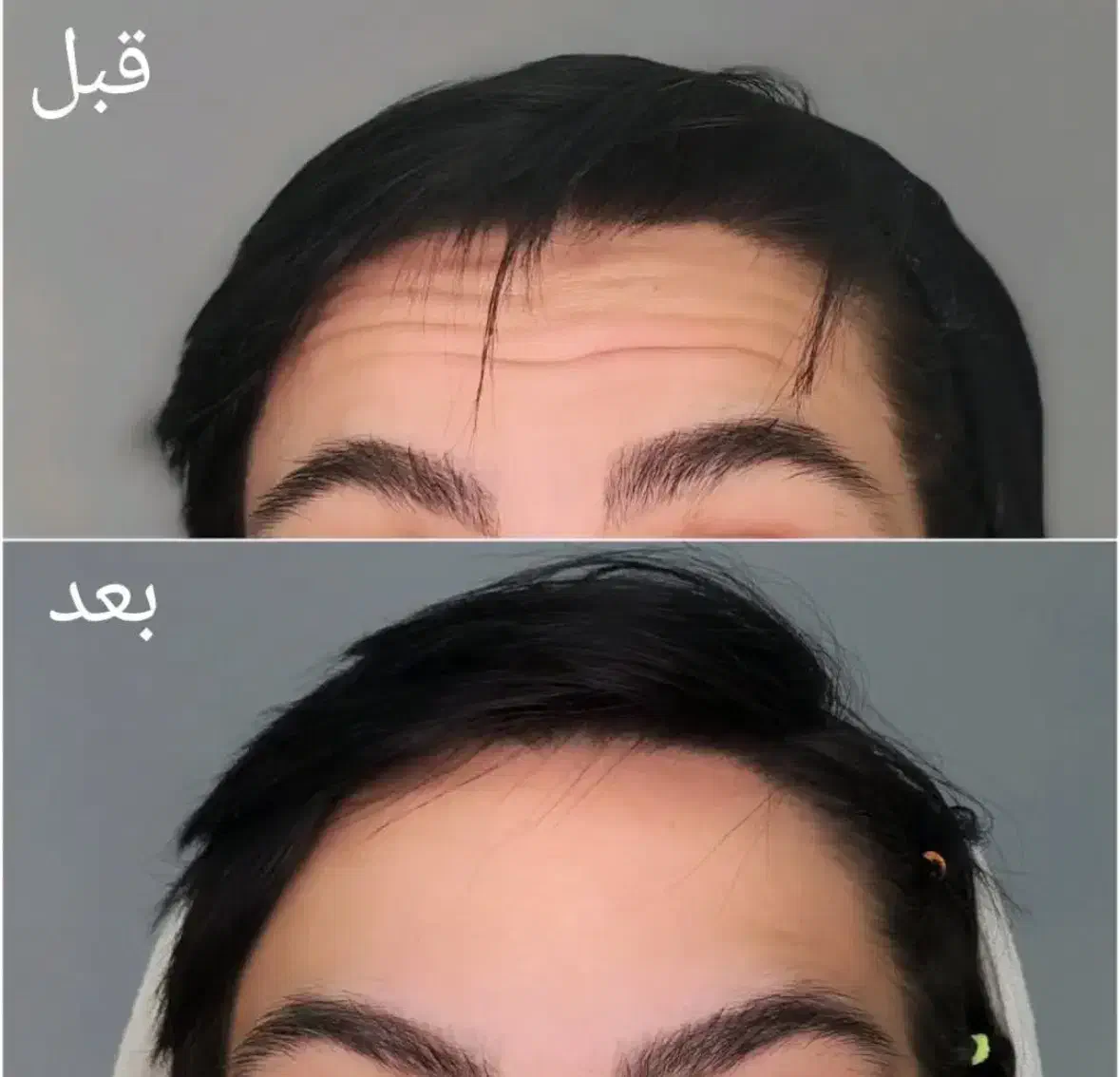 تزریق بوتاکس توسط پزشک ۷۸۰ت|خدمات آرایشگری و زیبایی|شیراز, کوی وحدت|دیوار