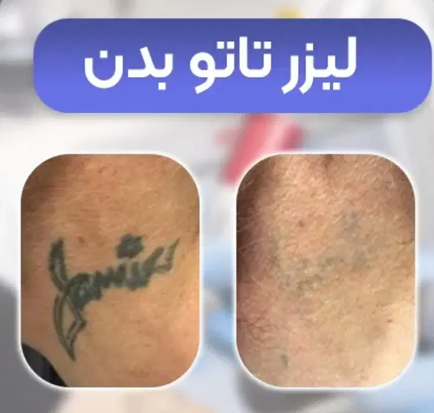پاک کردن تاتو با پیشرفته ترین لیزر حال حاضر دنیا|خدمات آرایشگری و زیبایی|کرمانشاه, |دیوار
