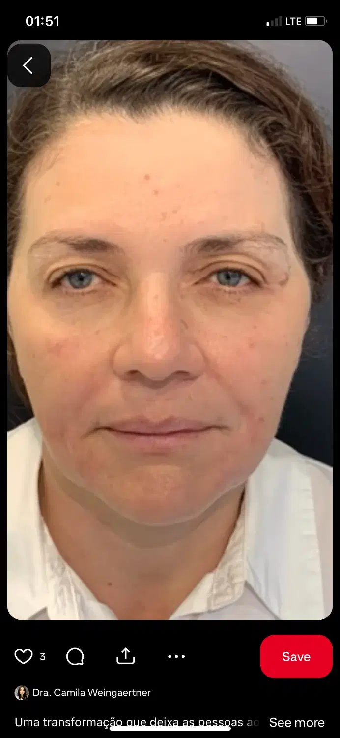 جشنواره تخفیف جراحی لیفت صورت|خدمات آرایشگری و زیبایی|کرج, مهرویلا جنوبی|دیوار