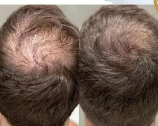 جشنواره prp و مزوتراپی ( آقایان و بانوان)|خدمات آرایشگری و زیبایی|بروجرد, |دیوار