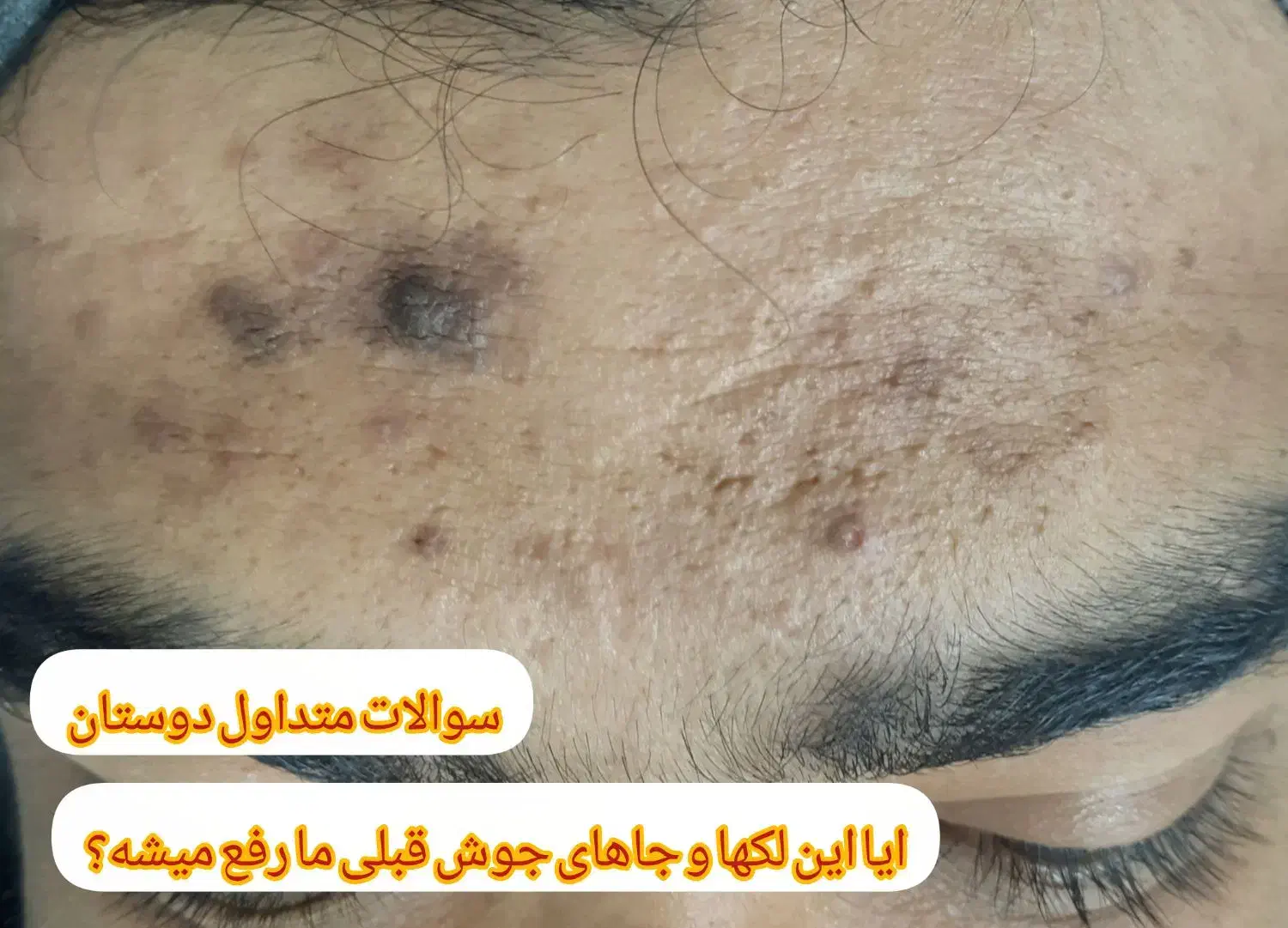 جای جوش و ابله و لک جوش|خدمات آرایشگری و زیبایی|دورود, |دیوار