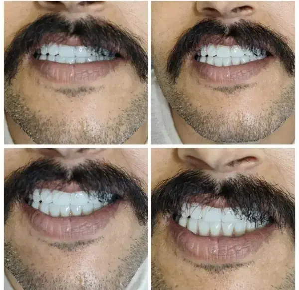 دندان مصنوعی اقساطی|خدمات آرایشگری و زیبایی|اصفهان, عطار نیشابوری|دیوار