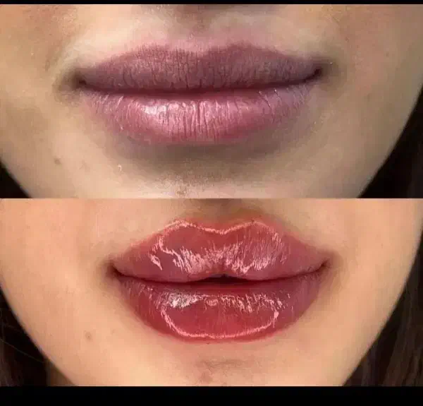 تزریق فیلر|خدمات آرایشگری و زیبایی|الشتر, |دیوار