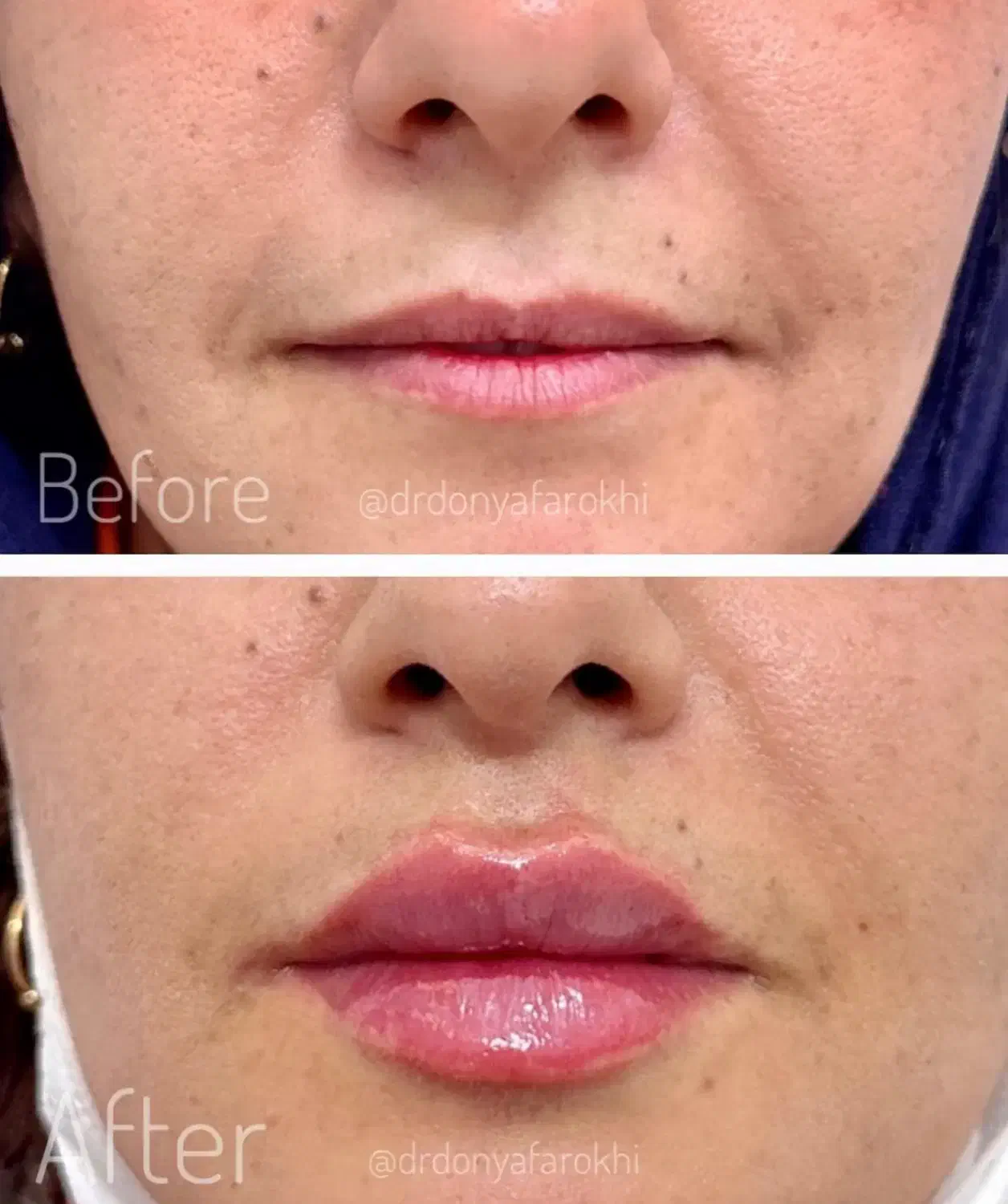 ژل بوتاکس لیزر لاغری مشاوره رایگان مطب دکتر فرخی|خدمات آرایشگری و زیبایی|اسلامآباد غرب, |دیوار