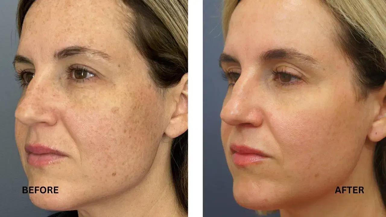 آف تزریق انواع مزوژل توسط شخص پزشک در مطب زیبایی|خدمات آرایشگری و زیبایی|لاهیجان, طالقانی|دیوار