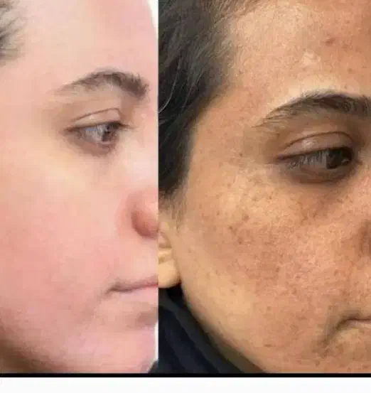 کرم روشن کننده خارجی مکمل چاقی صورت تضمینی|آرایشی، بهداشتی، درمانی|بندر ماهشهر, |دیوار