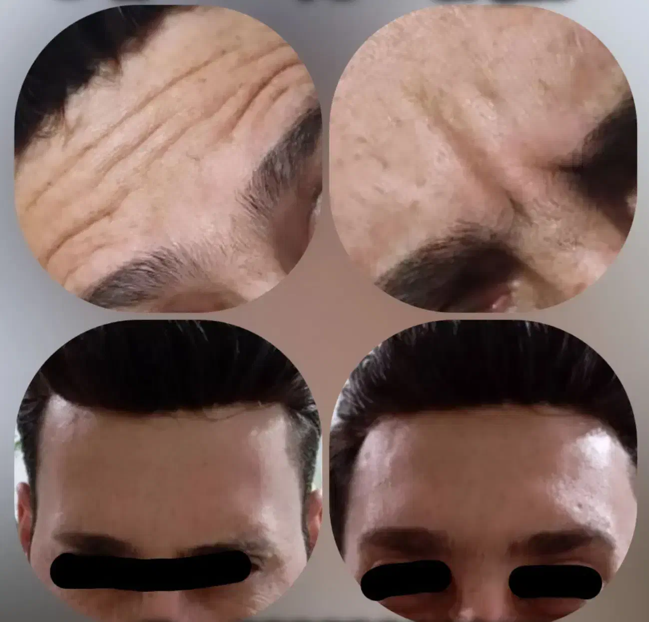 ژل و بوتاکس با ماندگاری بالا و قیمت ویژه|خدمات آرایشگری و زیبایی|شاهین‌شهر, شهرک گلدیس|دیوار