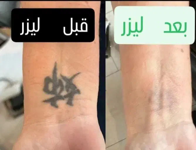 پاک کردن تتو با پیشرفته ترین لیزر کیوسوئیچ|خدمات آرایشگری و زیبایی|اهواز, کوی سعدی|دیوار