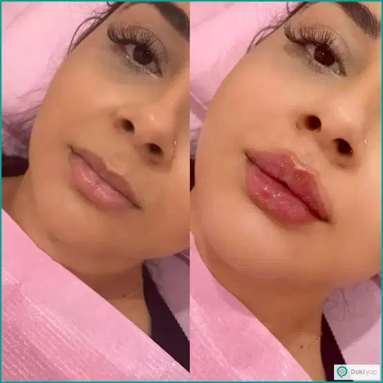 جشنواره تخفیف تابستانها تزریق ژل و بوتاکس|خدمات زیبایی و سلامت|تهران, شهرک ولیعصر جنوبی|دیوار