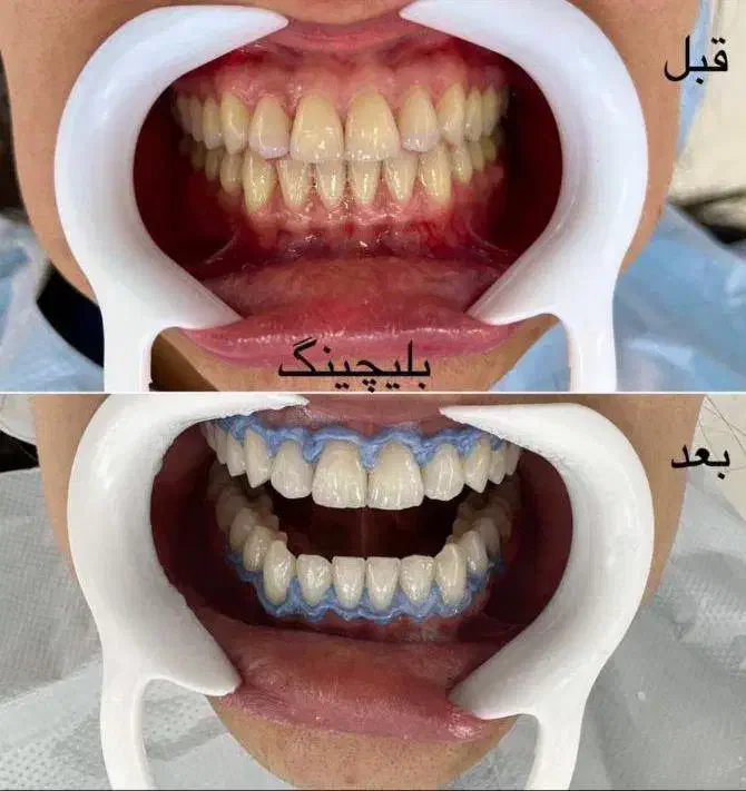 کامپوزیت دندان کامپوزیت زیبایی لمینیت دندان|خدمات آرایشگری و زیبایی|قم, قلعه یزدیها|دیوار