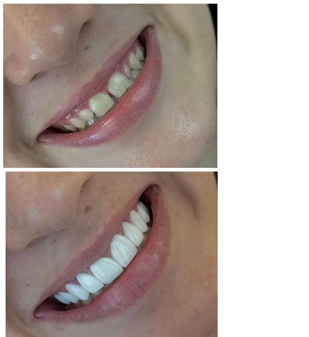 کامپوزیت ونیر آلمانی|خدمات آرایشگری و زیبایی|تهران, چیذر|دیوار