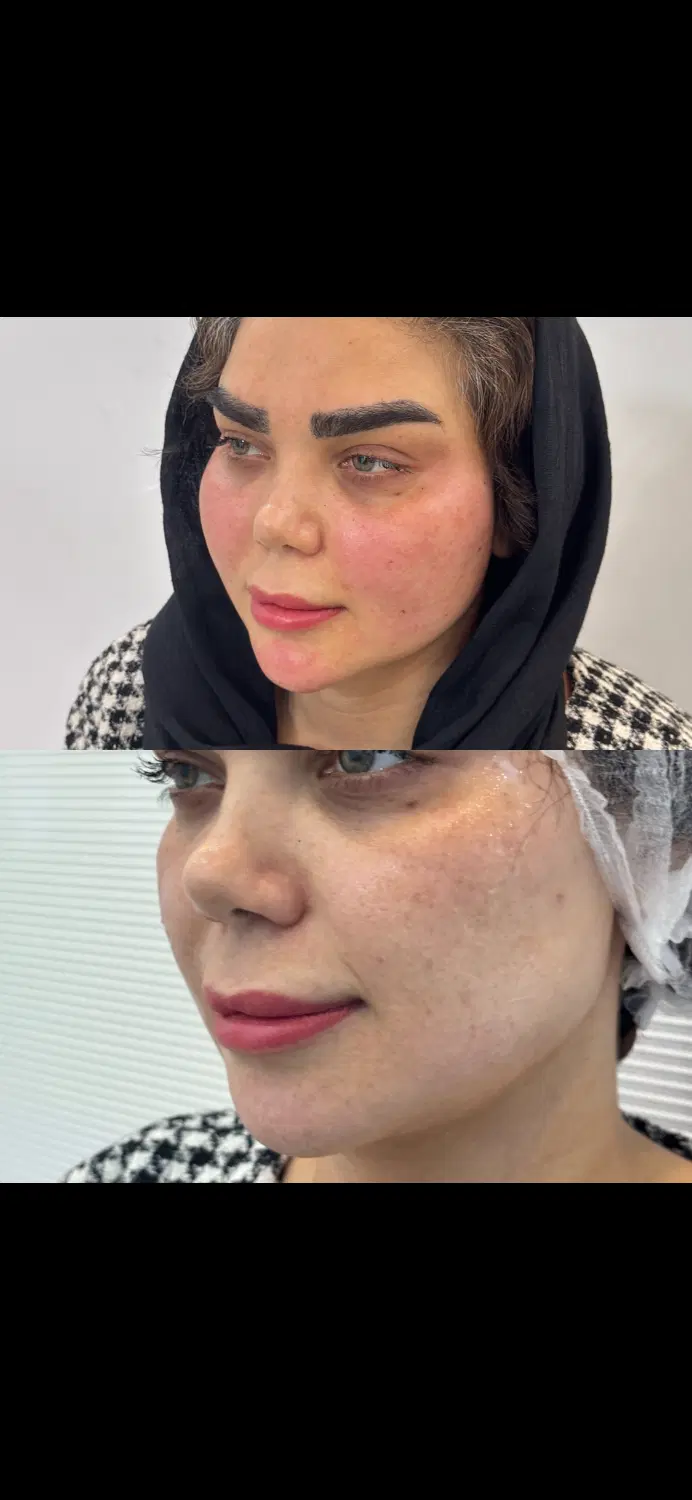 مدل جهت تزریق چربی/انجام بلفاروپلاستی|خدمات زیبایی و سلامت|تهران, شکوفه (عبدل آباد)|دیوار
