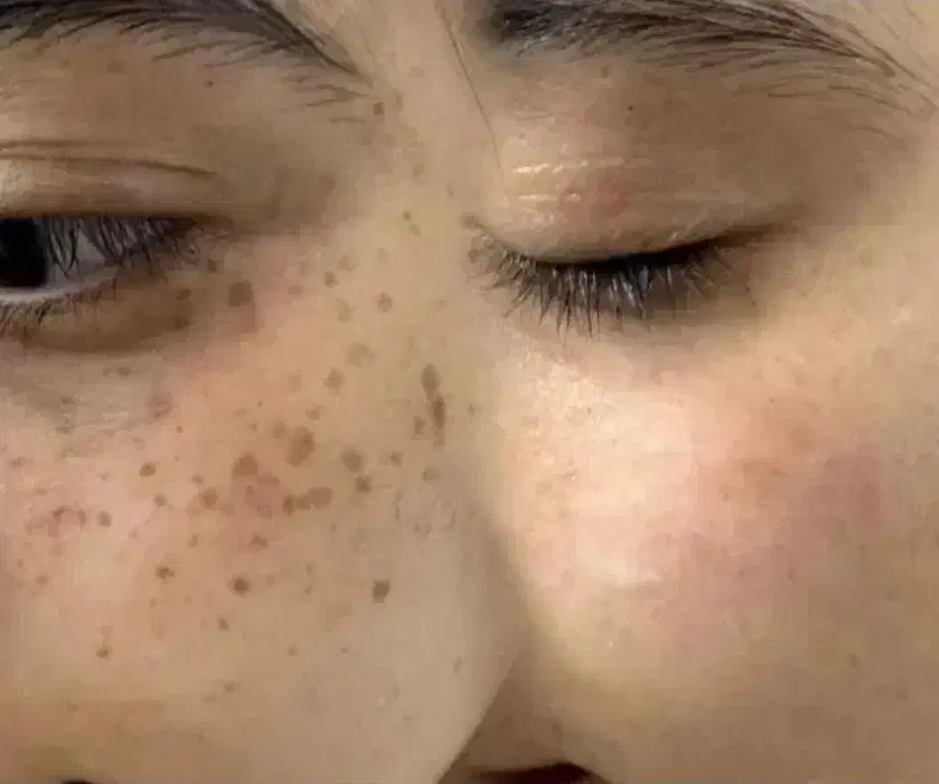 برداشتن خال.زگیل تناسلی.جای زخم و بخیه. میخچه|خدمات آرایشگری و زیبایی|کرمانشاه, |دیوار