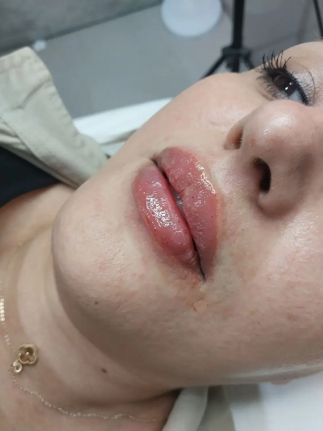 اموزش تزریقات زیبایی بوتاکس و فیلر و مزو|خدمات آموزشی|ارومیه, |دیوار