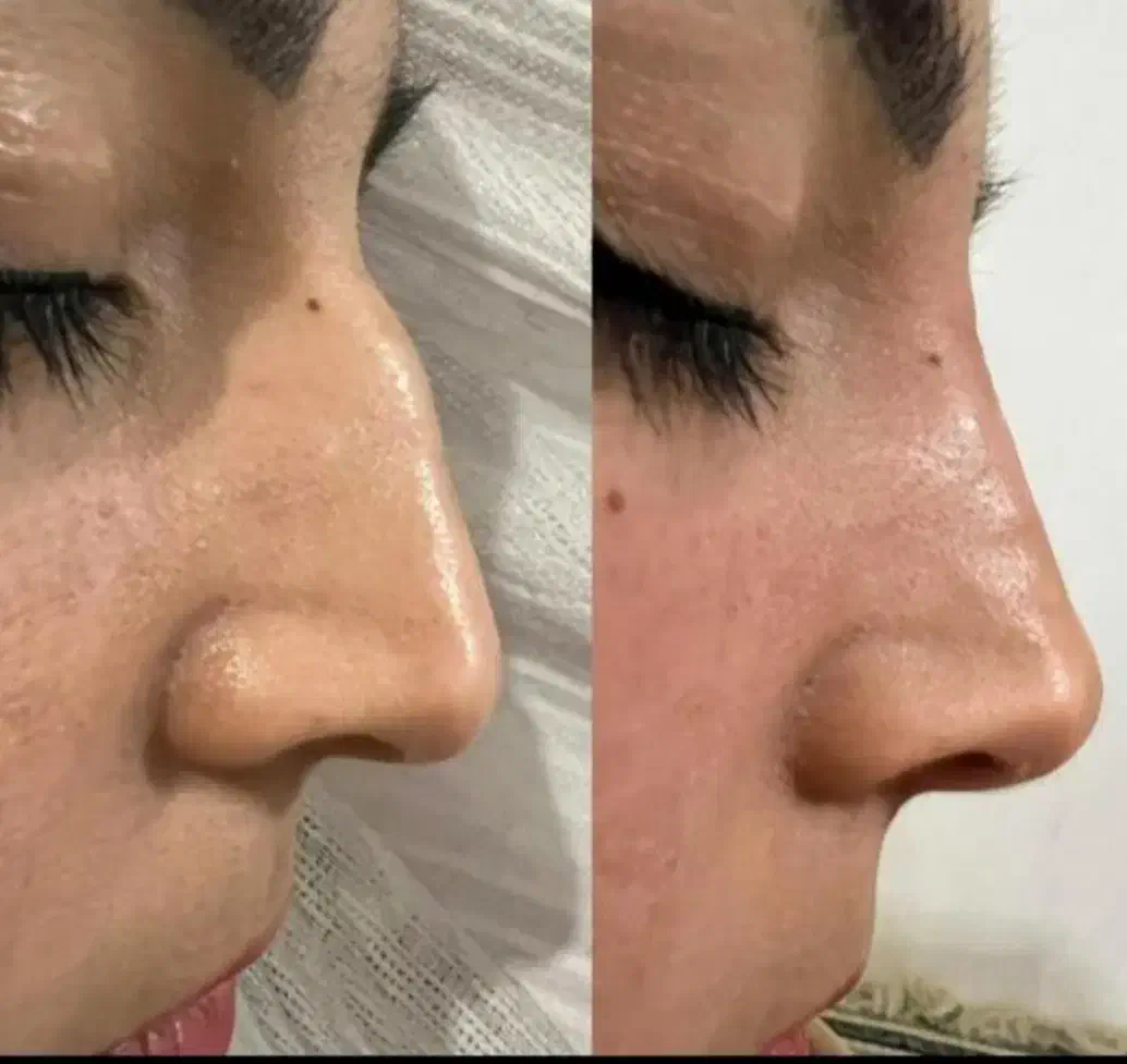 ژل و بوتاکس در منزل شما|خدمات آرایشگری و زیبایی|کرمانشاه, |دیوار