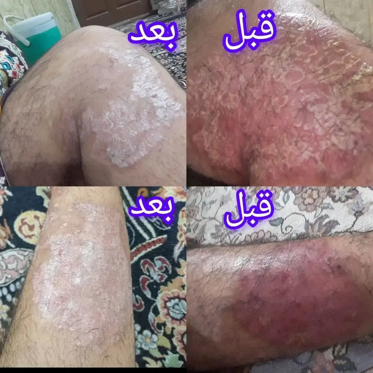 اگزمای پوستی|آرایشی، بهداشتی، درمانی|شیراز, پانصد دستگاه ارتش|دیوار