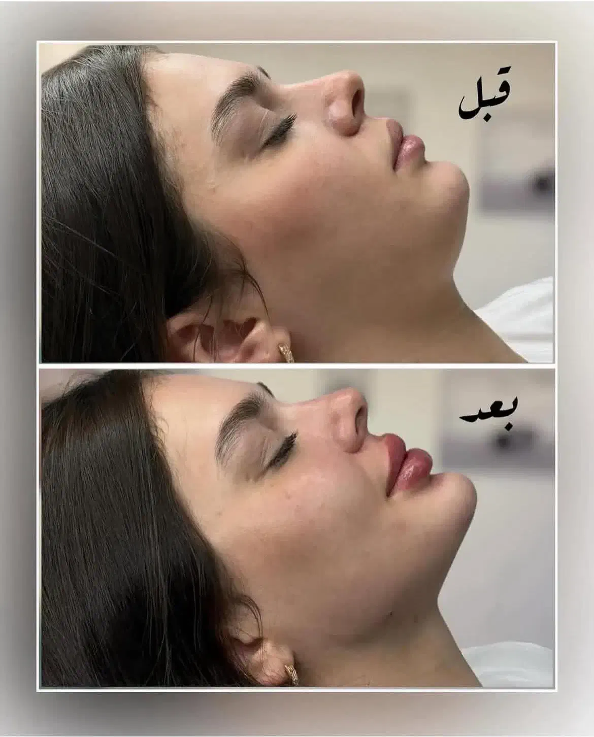 تزریق فیلر بوتاکس،نخ لیفتینگ بانصف قیمت بازار|خدمات آرایشگری و زیبایی|کرمانشاه, |دیوار