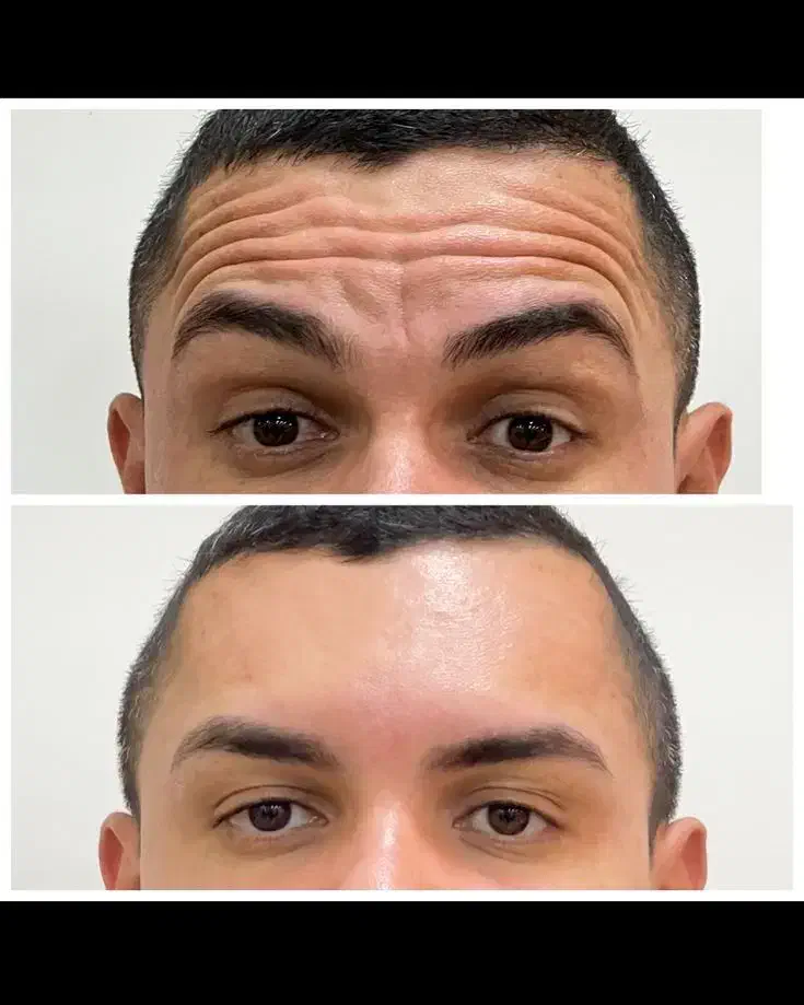 جشنواره ۵۰درصد تخفیف بوتاکس مخصوص خانم ها و آقایان|خدمات آرایشگری و زیبایی|دزفول, |دیوار