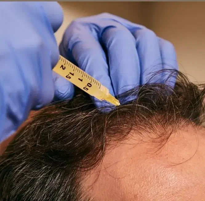 پی آر پی حجامت امبدینگ بادکش طب سوزنی فصد زگیل|خدمات آرایشگری و زیبایی|اصفهان, ملکشهر|دیوار