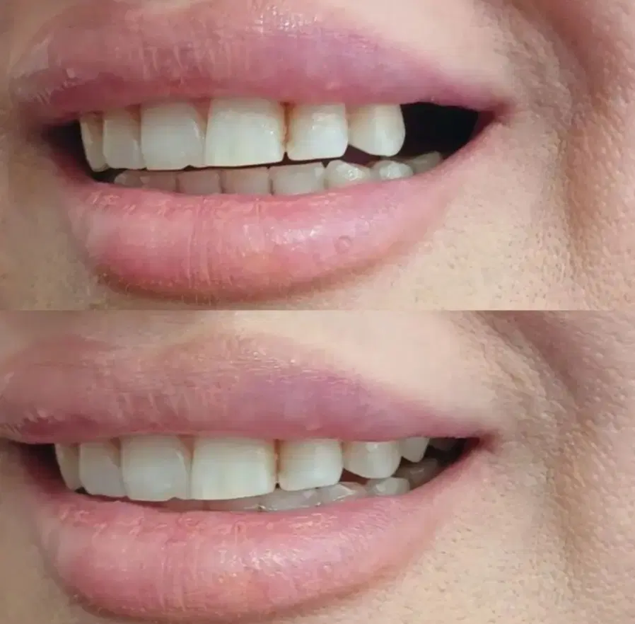 دندانسازی ( تحویل یک روزه )|خدمات زیبایی و سلامت|اصفهان, برزان|دیوار