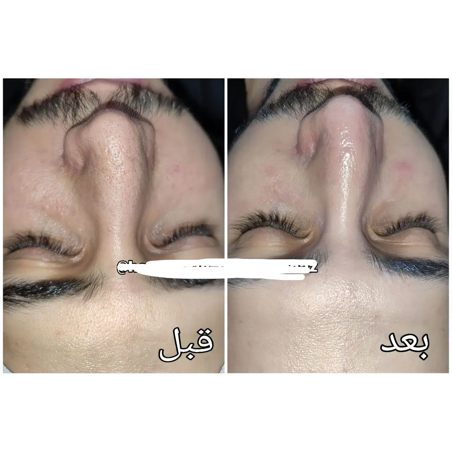 مدل فیشیال وی ای پی و درمان جوش|خدمات آرایشگری و زیبایی|تهران, مجیدیه|دیوار