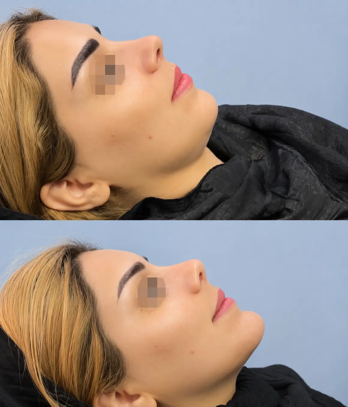 فیلر لب روسی فیلر زیر چشم فیلر گونه چانه توسط پزشک|خدمات زیبایی و سلامت|شیراز, ملاصدرا|دیوار