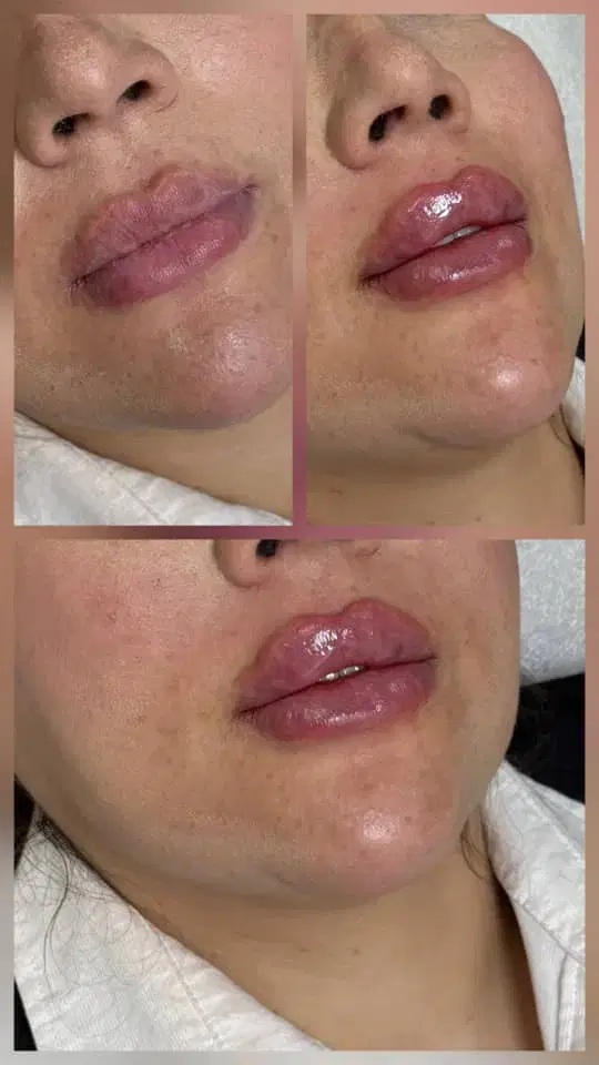 لیزرموهای زائد،ژل وبوتاکس،پی آرپی.فیلربادی،بلفارو|خدمات زیبایی و سلامت|تهران, شکوفه|دیوار