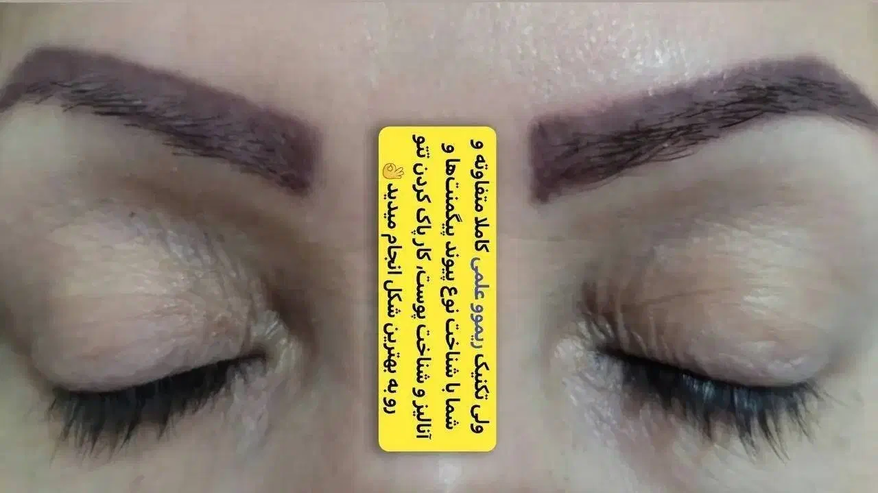 پاک کردن تاتوومیکروبلیدینگ بدون لیزر+آموزش بامدرک|خدمات آموزشی|تهران, جی|دیوار