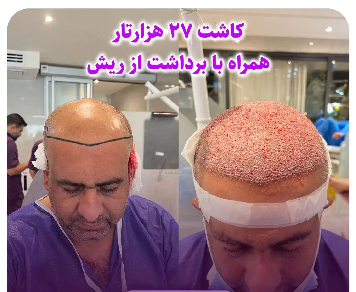 کاشت مو فول تراکم با ضمانت در شیراز|خدمات آرایشگری و زیبایی|لردگان, |دیوار