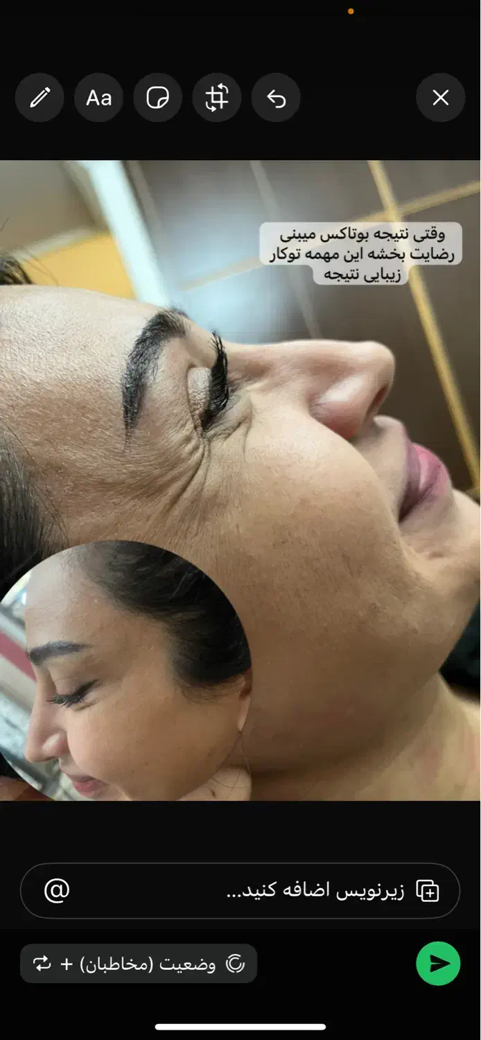 تخفیف ویژه یلدایی بوتاکس و‌فیلر(ژل)|خدمات آرایشگری و زیبایی|ارومیه, |دیوار