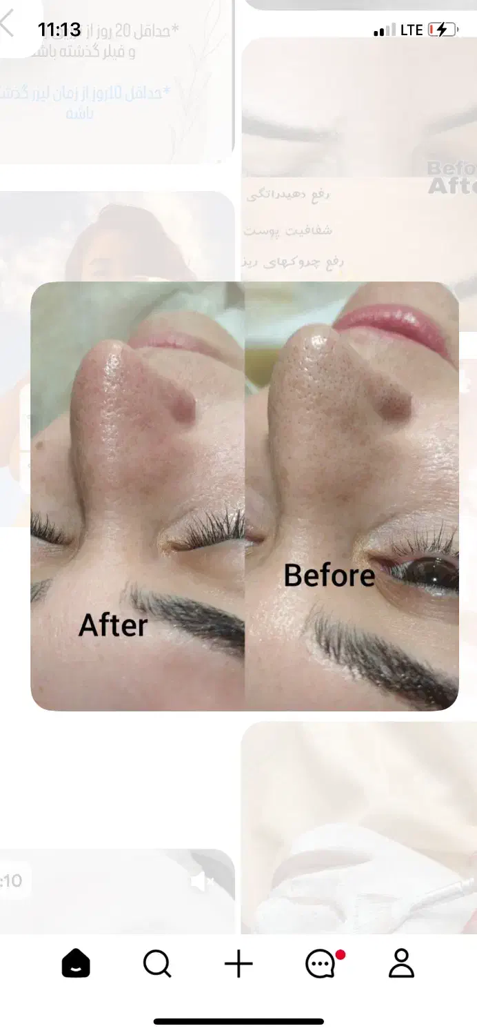 اصلاح درماپلینگ قیمت باورنکردنی|خدمات آرایشگری و زیبایی|بیرجند, |دیوار