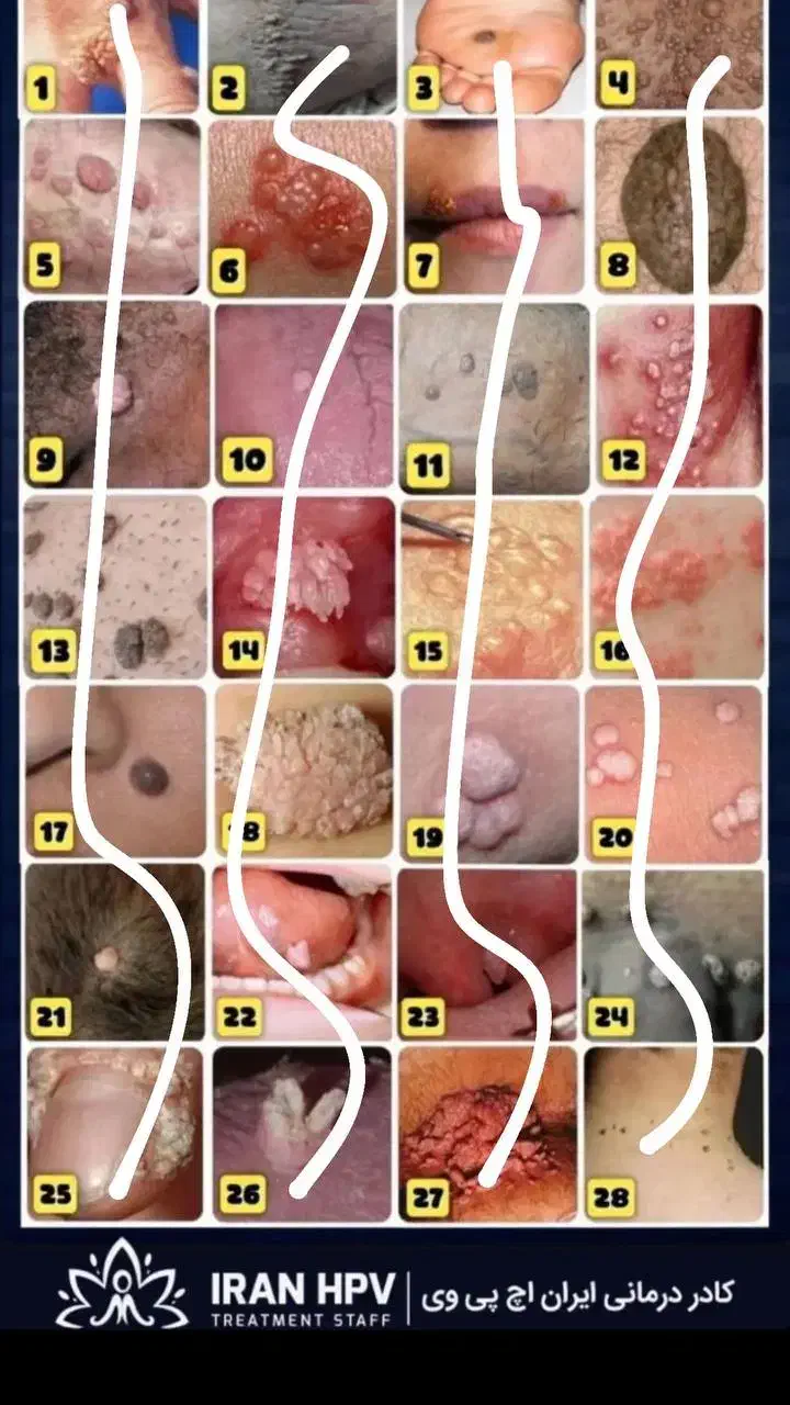 بیماری های ویروسی زگیل و تبخال|خدمات آرایشگری و زیبایی|خمینی‌شهر, |دیوار