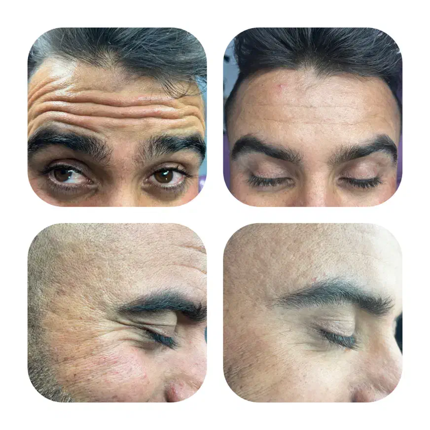 تخفیف بوتاکس،ژل لب،پی ار پی فقط تا فردا(۱ آبان)|خدمات آرایشگری و زیبایی|یاسوج, |دیوار