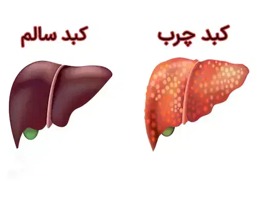 پکیج درمان کبد چرب|آرایشی، بهداشتی، درمانی|شهرکرد, |دیوار
