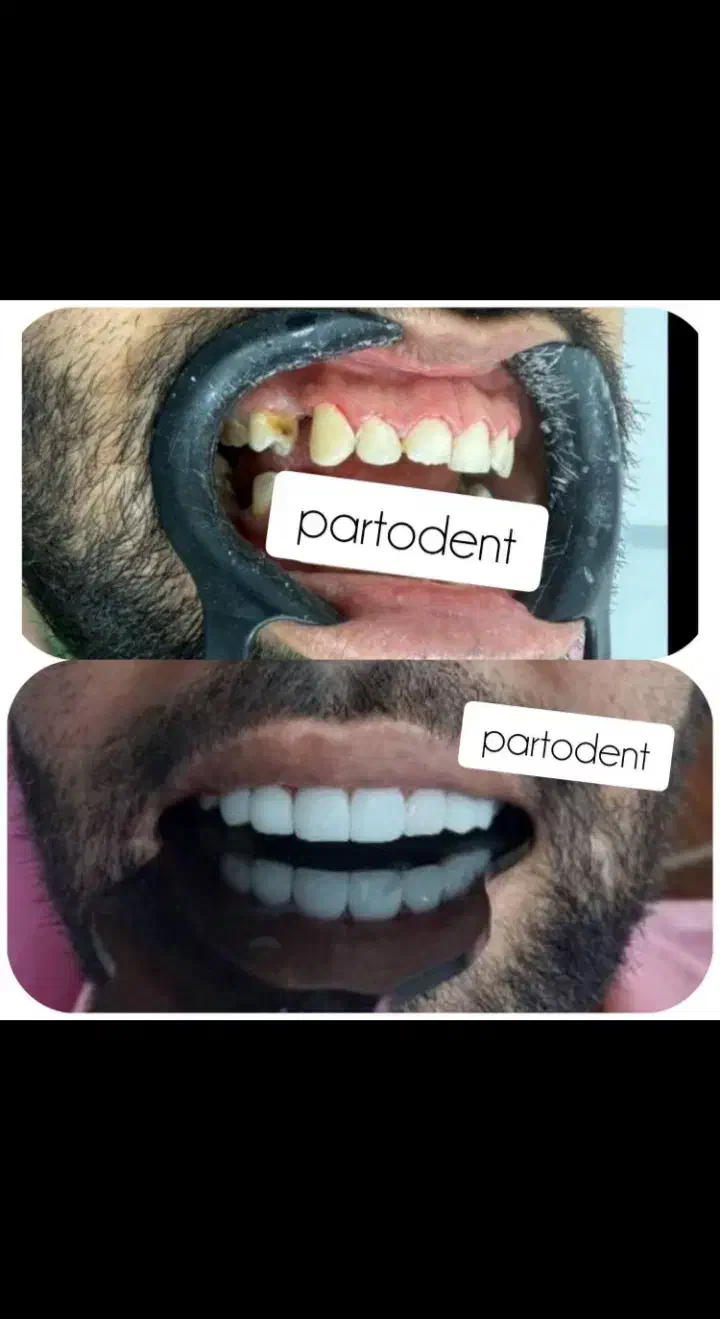 کامپوزیت در منزل. ایذه، باغملک، هفتکل|خدمات آرایشگری و زیبایی|ایذه, |دیوار