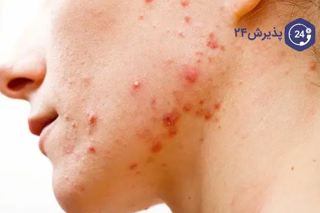 راهنمایی کنید دکتر پوست جوش صورت|فعالیت داوطلبانه تحقیقاتی|کرمان, |دیوار