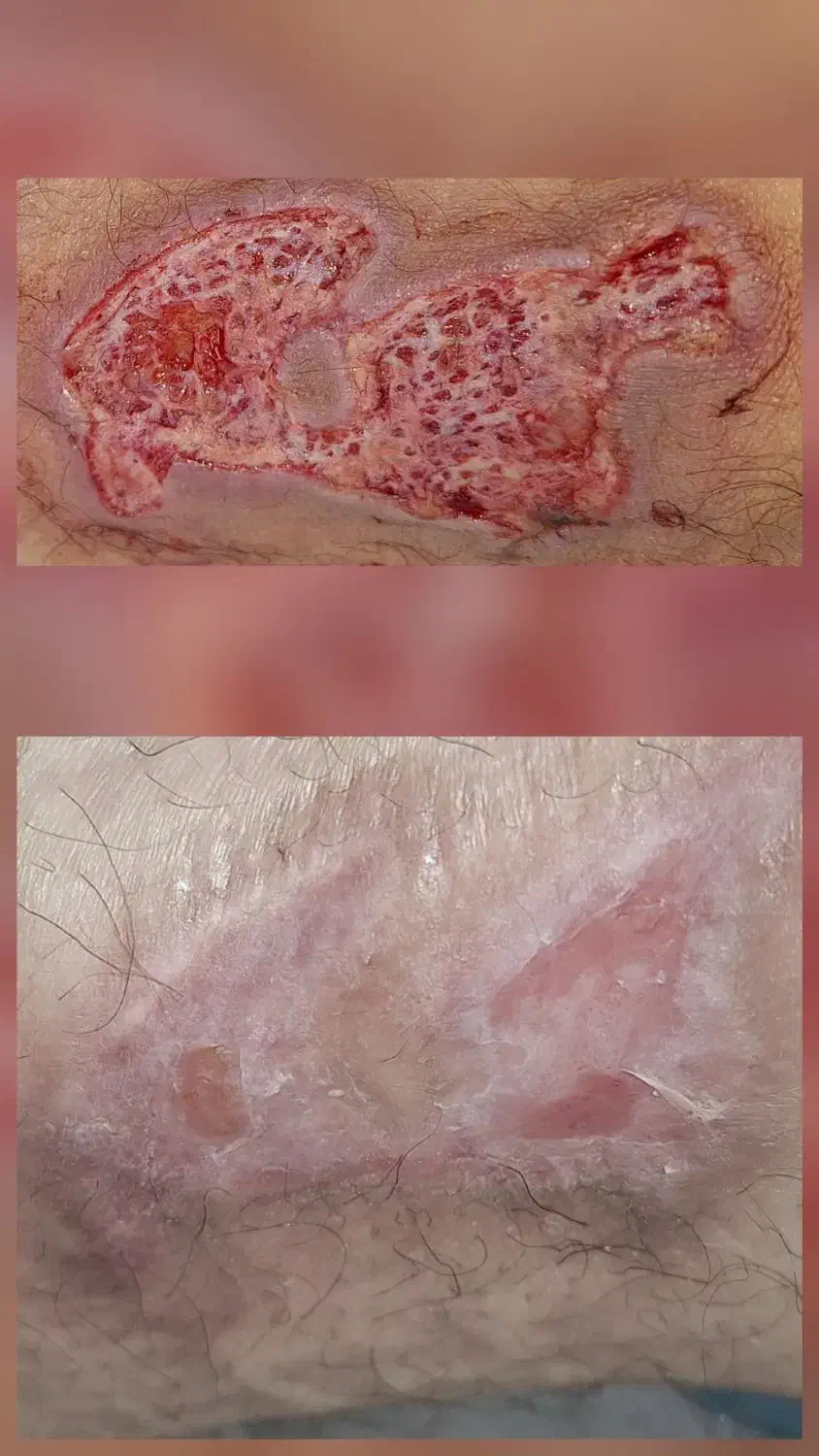 کارشناس و درمانگر زخم ،خدمات پرستاری در منزل|خدمات آرایشگری و زیبایی|برازجان, |دیوار