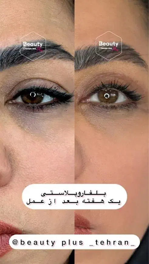 تخفیف ساکشن شکم پهلو و پشت/ هر ناحیه از بدن/بلفارو|خدمات آرایشگری و زیبایی|قم, زنبیل آباد|دیوار